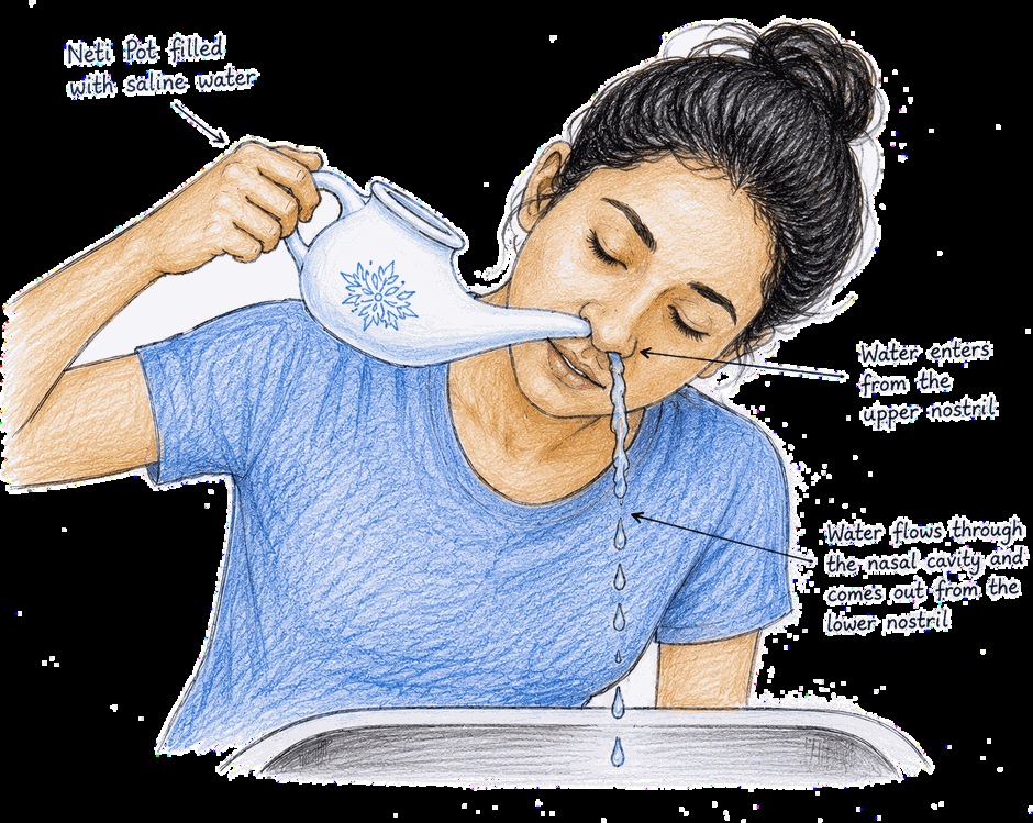 Neti pot filled with saline water poured into the upper nostril, flowing through the nasal cavity and out of the lower nostril